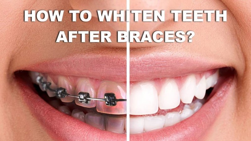 White Teeth with Braces